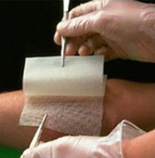 CHLORHEXIDINE GAUZE DRESSING